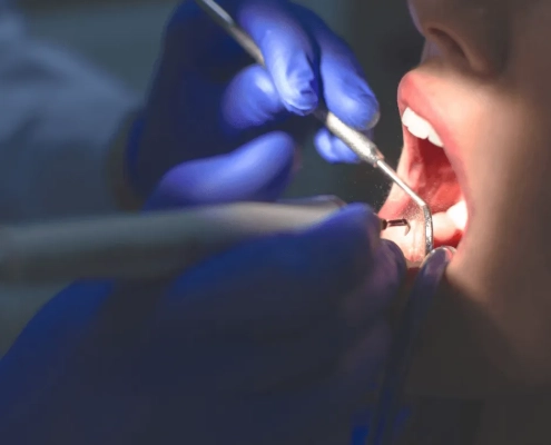 Oaks Dental Group Cleaning Images